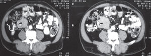 Abdominal computed tomography scan evidences thickening of jejunal wall.