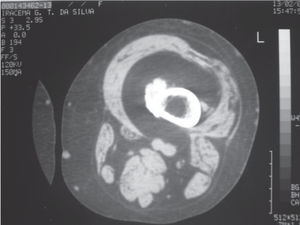 Computed tomography: window of soft parts (axial view) where an intramuscular expansive process can be seen around the femur, with the radiodensity of fat. Note the hyperostosis in the cortical medial area of the bone without medullary invasion.