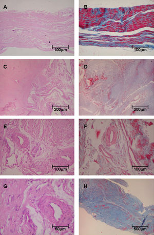 Tendon samples obtained from control and posterior tibial tendon dysfunction (PTTD) patients, stained with Hematoxylin & Eosin (Panels A, C, E, G) and Masson’s trichrome (Panels B, D, F, H). Control tendons display normal architecture with parallel or linear orientation of collagen bundles and a low degree of vascularization (A) and (B). In contrast, (C) and (D) show tendon specimens from PTTD patients with architecture distortion and large pale areas with a wavy pattern of collagen bundles. In panels (E), (F) and (G), tendons from PTTD patients show increased vessels with complex branching caused by proliferation of fibroblasts and myxoid stroma. In (H), the final results of the remodeling process of tendonitis in PTTD are shown. (Original magnification: X 40 in panel H; X 100 in panel A, B, C, D and H; X 200 in panels E and F; X 400 in panels G)