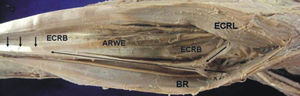 Superior-lateral view of the right forearm region. ARWE, additional radial wrist extensor. The downward arrows indicate its course, already shown in figure 3a. BR, brachioradialis. Note the additional muscles arising both from the BR (lateral) and ECRL (medial), joining to form a single muscle on its way to be inserted into the tendon of the ECRB.