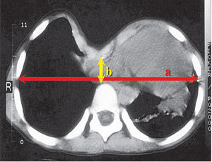 Measurement of the pectus severity index using a CT scan. This is calculated by dividing the inner width of the chest at the widest point (a) by the distance between the posterior surface of the sternum and anterior surface of the spine (b)