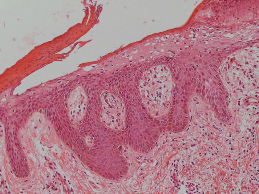 Necrolytic Migratory Erythema Associated with Glucagonoma: A Report of ...