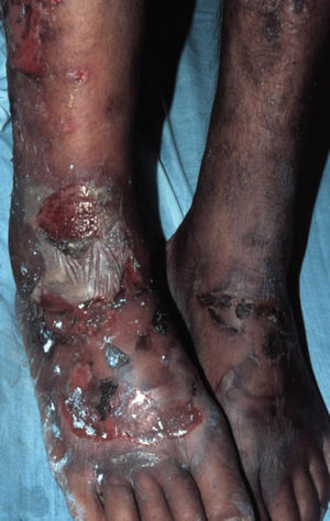 Tense bullous lesions with purulent content and pellagroid eczematous plaques on the anterior surface of the legs and feet, associated with purpura and edema