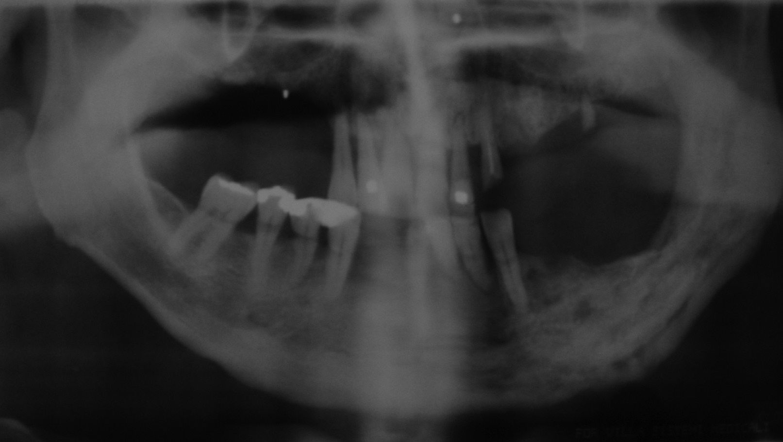 Bisphosphonates and Osteonecrosis of the Jaw: A Case Report | Clinics