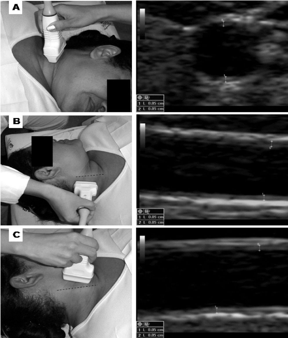 A Practical Protocol to Measure Common Carotid Artery Intima-media ...