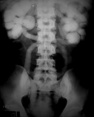 Intravenous urography showing bilateral ureterohydronephrosis and delayed contrast excretion. (150 minutes)