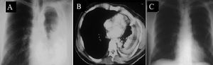 A. Chest roentgenogram shows a large left empyema. B. Computed tomography of the chest showing significant restriction of the thoracic cage and thick pleural cortex. C. Postoperative chest roentgenogram with excellent pulmonary expansion (Incidentally, partial removal of a rib can be seen; this was the only patient that required such a procedure)