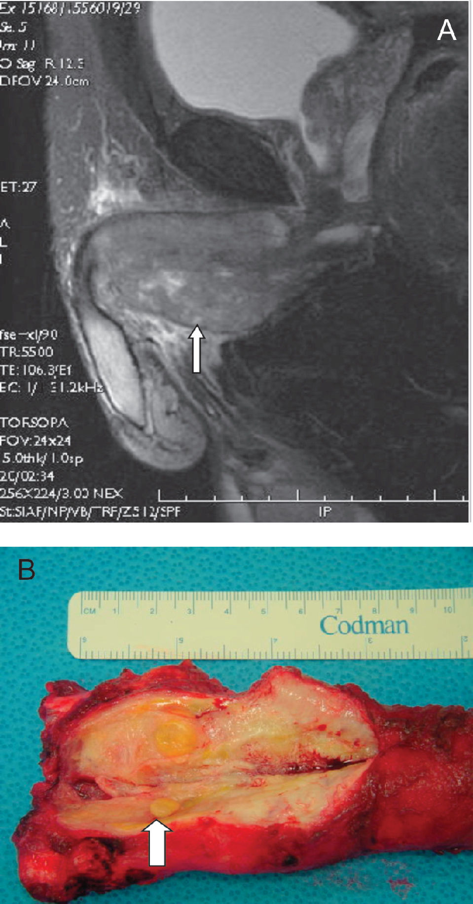 Pleomorphic Undifferentiated Sarcoma of the Penis | Clinics