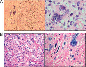 Undifferentiated Pleomorphic Sarcoma of the penis (HE, X100). B- Immunohistochemical panels, negative for all tested antibodies (CD117- CKit, HHF35, Desmin, CD34-KBEND10, CD31- JC70A, F100 protein, AE1AE3, EMA and CD20, 45, 30)