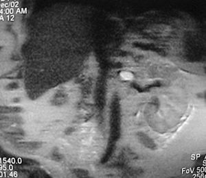 MRI demonstrating the Foley catheter balloon inside the left renal vein