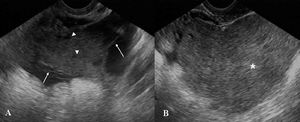 Transvaginal pelvic ultrasound images (A,B) showed a complex retrouterine mass with a homogeneous solid component (*, B) and cystic areas (arrowhead, A) intermingled with linear septa (arrow, A)