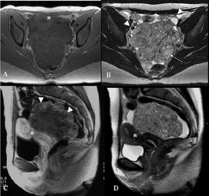 Pelvic MR exam. Axial GRE T1-weighted (A), axial TSE 512 T2-weighted (B), sagittal post-contrast GRE T1-weighted image and (D) sagittal TSE T2-weighted images. There is a large, expansive, well-delimited lesion with lobulated contours; the T1-weighted sequence shows homogeneous signal intensity predominately with a low signal, and T2-weighted sequences are heterogeneous with small high-intensity foci (arrow). The lesion dislocated the ovaries (arrowheads, B) anterolaterally and the uterus (*, A,C and D) anteriorly. After intravenous injection of paramagnetic contrast agent, there was a heterogeneous enhancement of the lesion that was more evident peripherally (arrowheads, C)