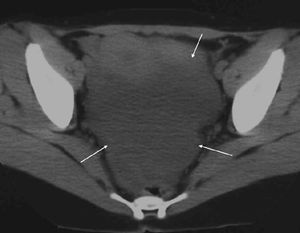 Computed tomography with no intravenous contrast agent revealed that there was no calcification within the mass (arrows)