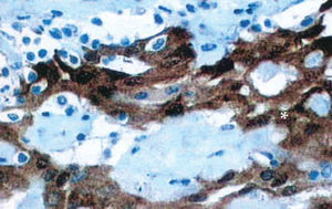 The histopathologic section shows calretinin staining for well-differentiated mesothelial cells (*), which confirms the mesothelial origin of the tumor