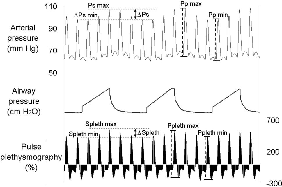 Spo2 Wave Variation Pulse Oximetry Wave Variation as a Noninvasive Tool to Assess Volume ...
