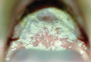 Severe pseudomembranous candidosis (Thrush) in HIV disease