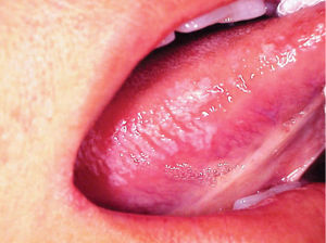 Oral hairy leukoplakia – this finding can also be a feature of iatrogenic immunosuppression