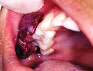 Kaposi’s sarcoma of the right buccal vestibule in an undiagnosed HIV-infected patient