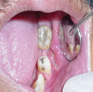 Necrotic oral mucosal ulceration, possibly associated with CMV in severe HIV disease