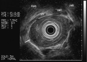 Endoscopic ultrasound: absence of tracheobronchial invasion by neoplasia. LN (lymph node); RMB (right main bronchus); LMB (left main bronchus)