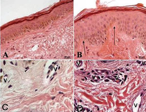 Photomicrograph of a histological gluteal skin section from a patient before (A, C) and after (B, D) treatment with isoflavones. A - Note the absence of the dermal papilae and a thin epidermal layer. B - Note the increased epidermal thickness. C and D - Note the blood vessels. The arrows indicate the dermal papillae, and “v” are the vessels. (A and B 250x; C and D 450x, H.E.)