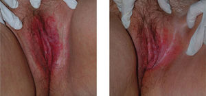 Before and after treatment with PDT