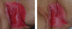Before and after treatment with PDT
