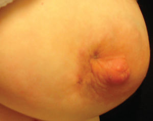 A large tender mass was felt in the inner half of the left breast, and a sinus tract was present near the nipple