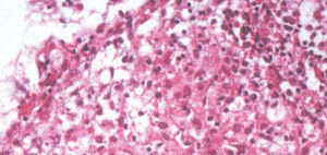 Tissue biopsy demonstrating the formation of epithelioid granulomas with Langerhans giant cells and lymphohistocytic aggregates, HE400x