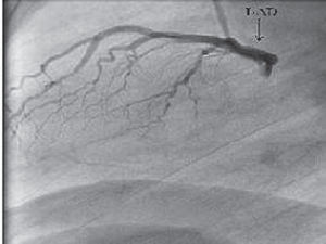 Coronary angiography from the left lateral view, not showing the circumflex artery.