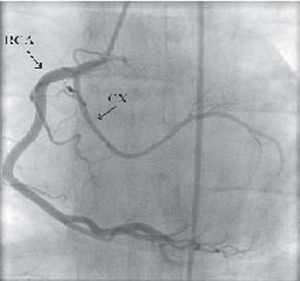Anomalous circumflex arising from the right coronary artery.