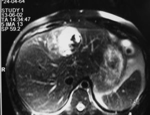 T2-weighted liver MR image shows a hyper-intense mass located in segment IV