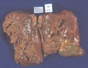 Spontaneous rupture hepatocellular adenoma showing areas of hemorrhage and liver parenchyma damage