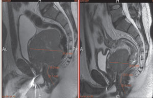 Pre- and post-treatment MRI (sagittal) illustrating the reduction in tumor size