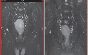 Pre- and post-treatment MRI illustrating the reduction in tumor size