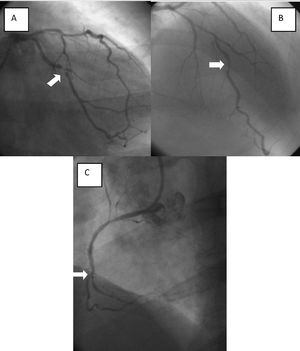 A. Circumflex coronary artery with 95% obstruction. B. Anterior descending coronary artery with 70% obstruction. C. Right coronary artery with a 100% distal occlusion
