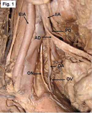 Right side of a pelvis showing the origin of the obturator artery (OA) from the posterior division (PD) of the internal iliac artery (IIA). AD- anterior division, EIA- External iliac artery, ON- obturator nerve, OV- obturator vein