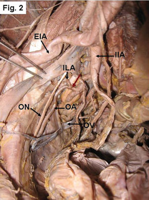 Right side of a pelvis showing the origin of the OA from the PD of the IIA with the iliolumbar artery (ILA). The red arrow indicates the common trunk. EIA- external iliac artery, ON- obturator nerve, OV- obturator vein