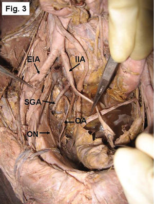 Right side of a pelvis showing the origin of the OA from the posterior division of the IIA with the superior gluteal artery (SGA). EIA- external iliac artery, ON- obturator nerve