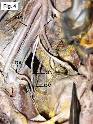 Right side of a pelvis showing the origin of the OA from the external iliac artery (EIA). IIA- Internal iliac artery, ON- obturator nerve, OV- obturator vein