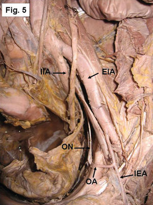 Left side of a pelvis showing the origin of the OA from the EIA with the inferior epigastric artery (IEA). IIA- Internal iliac artery, ON- obturator nerve.