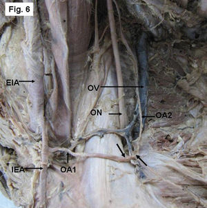 Right side of a pelvis showing the dual origin of the OA from both the EIA (OA1) and IIA (OA2), and forming an anastomotic structure (arrows). IEA- Inferior epigastric artery, ON- obturator nerve, OV- obturator vein