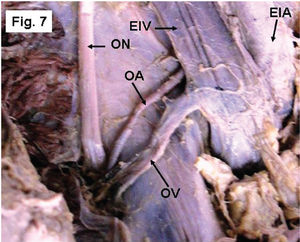 Left side of a pelvis showing the OA arising from the EIA and advancing posterior to the external iliac vein (EIV) to reach the pelvic cavity. ON- obturator nerve, OV- obturator vein