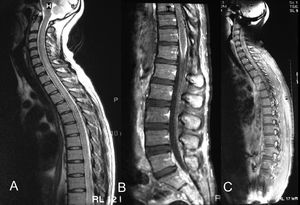 Non-contrast T2-weighted image showing a diffuse high-signal intensity inside the cervical and thoracic spinal cord (a). Contrast sagittal T1-weighted image showing diffuse meningeal enhancement over the conus medullaris (b). The parenchyma was enhanced heterogeneously on the contrast T1-weighted image (c)