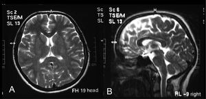 Transverse (a) and sagittal (b) T2-weighted image showing normal cranial MR findings