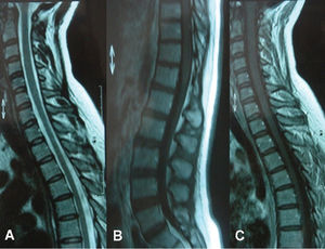 Non-contrast T2-weighted image of the cervical and thoracic spinal cord (a), contrast sagittal T1-weighted image of the conus medullaris (b), and contrast T1-weighted image of the cervical and thoracic spinal cord (c) reveal normal findings