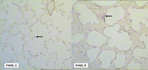 Panel A: Weigert stained section (magnification X20). Elastin fiber deposition in lung parenchyma at the Air group. There is an organization of elastin fiber in the secondary alveolar septa (arrow). Panel B: After hyperoxic stimuli there is an evident disorganization and abnormal deposition of elastin fibers in the lung intersticium (arrow).