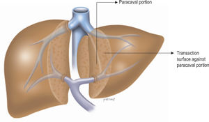Anterior approach after opening the interlobar plane and exposing the anterior surface of the paracaval portion and the hilar plate. The paracaval portion is detached from the hilar plate