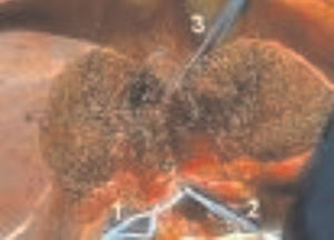 Anterior approach to the liver for resection of the paracaval portion of the caudate lobe. Isolation of the portal pedicle (1, 2) and supra-hepatic inferior vena cava (3)