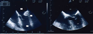 Transesophageal visualization of the mass (left panel) and trans-esophageal examination repeated nine months later, showing the disappearance of the mass (right panel). LV: left ventricle; LA: left atrium; RA: right atrium; Ao: Aorta; *: Caseous calcification of the mitral annulus.